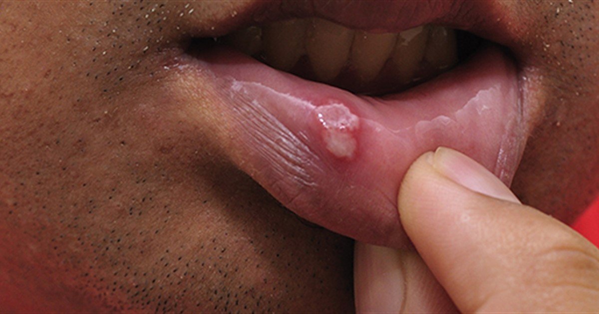 Mouth ulcers - Oral Health Foundation