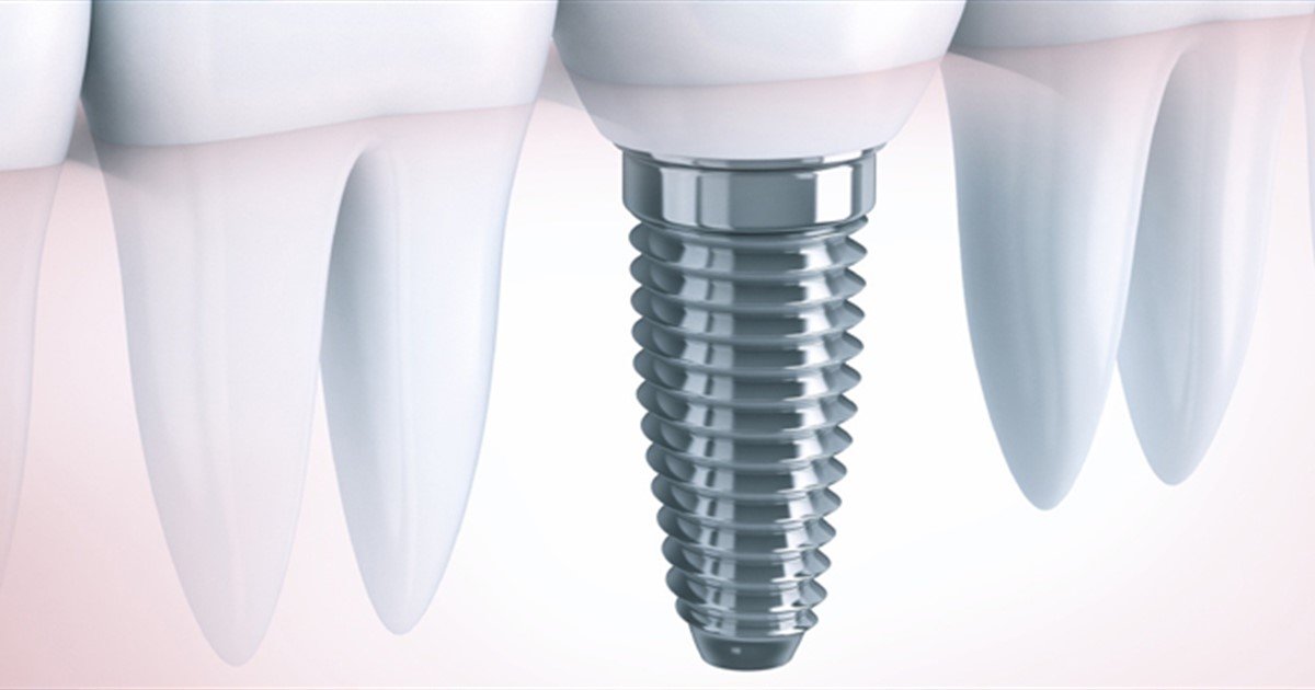Implants - Oral Health Foundation