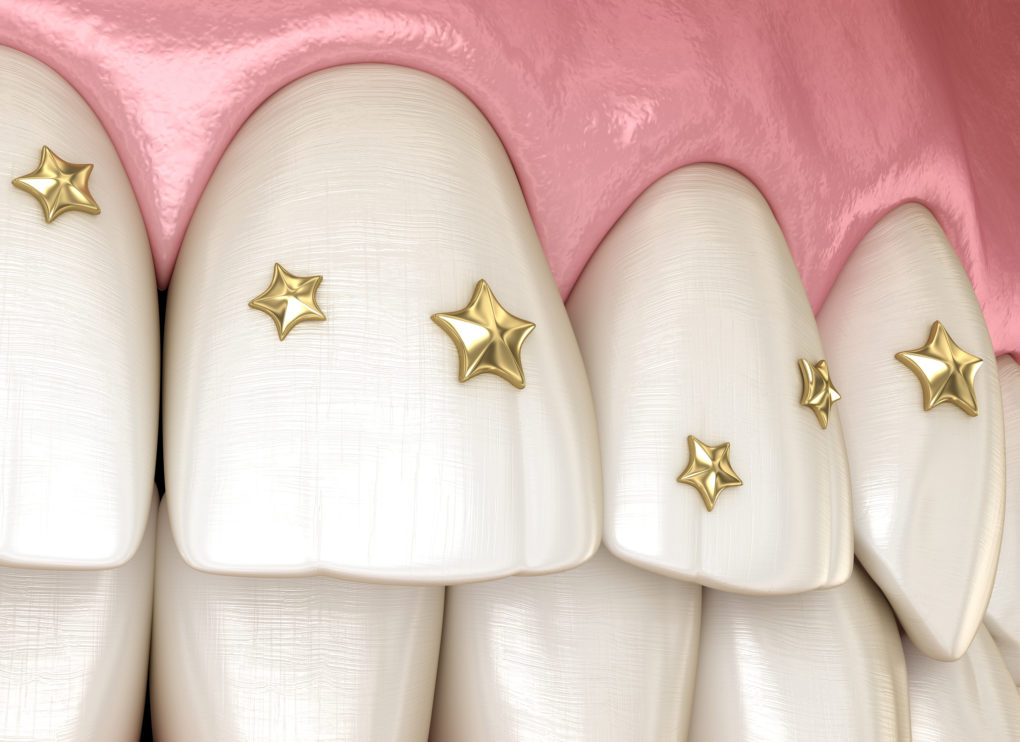 History and risks of bejeweled teeth